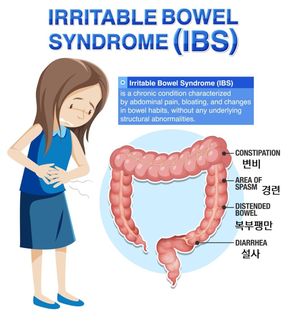 과민성대장증후군