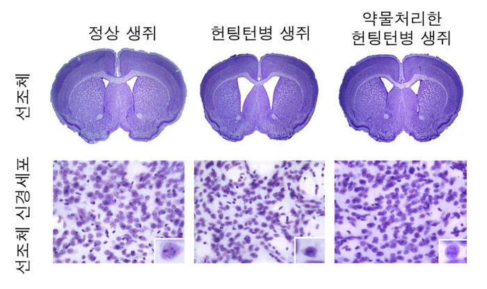 헌팅턴무도병-치료