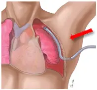 폐기흉 증상 원인과 치료, 수술 비용 · 군대 면제까지 총정리 폐기흉 진단