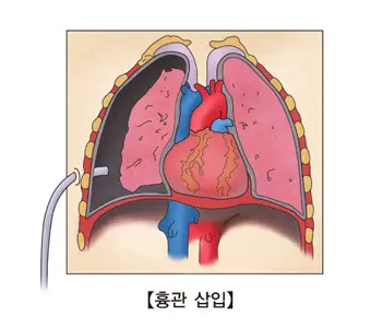폐기흉 증상 원인과 치료, 수술 비용 · 군대 면제까지 총정리 폐기흉 치료
