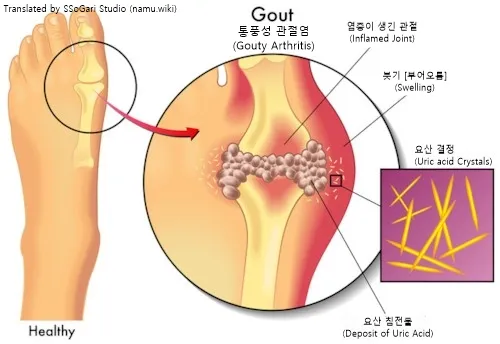통풍 환자 등푸른 생선 먹어도 될까? 고등어 삼치 퓨린 함량 비교 통풍