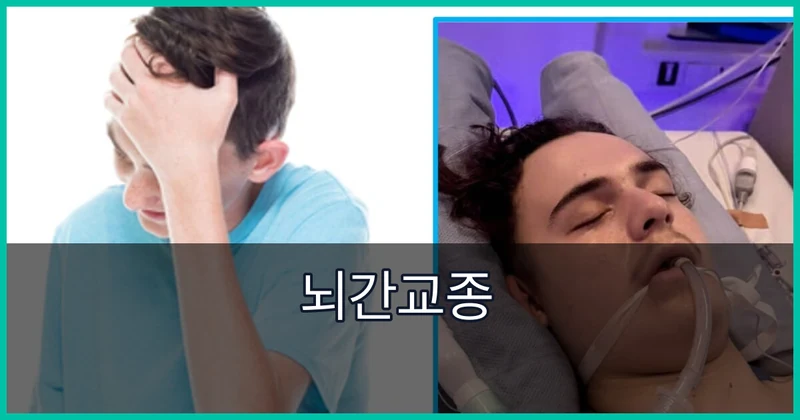 뇌간교종